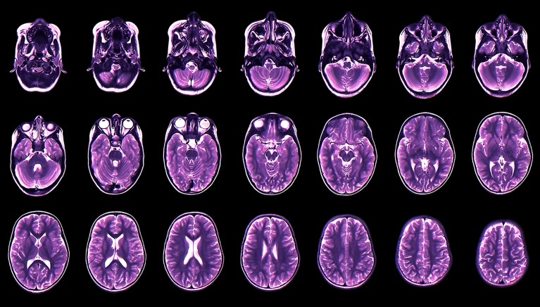 A series of twenty-one coloured magnetic resonance imaging scans in axial section of the healthy brain of a young boy.