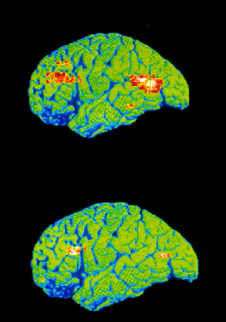 Two color PET brain scans.
