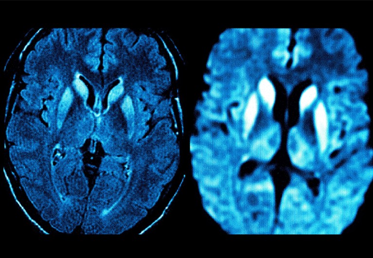 Treatment hope for CreutzfeldtJakob disease
