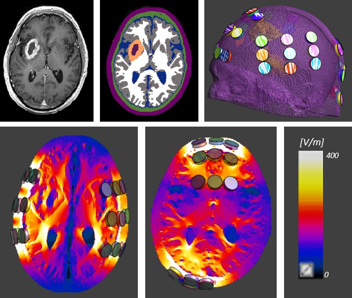 Head phantom with transducers and simulated Tumor Treating Fields intensity in brain tissue