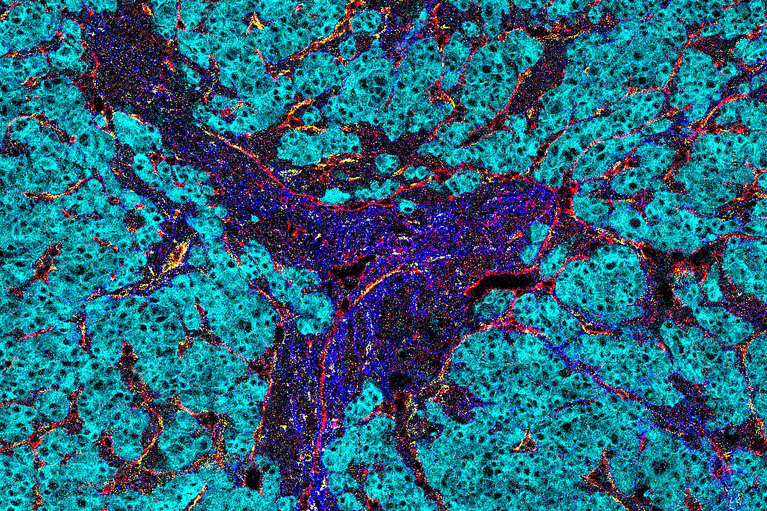 Approaching The Liver Cancer Microenvironment With A New Lens