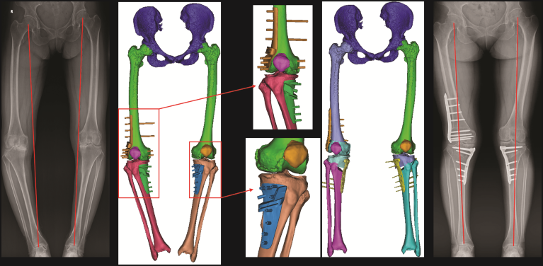 Improving Bone And Muscle Health In An Ageing Population