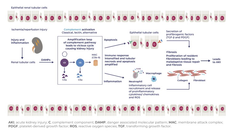 A diagram showing the progession from injury and inflamation to AKI