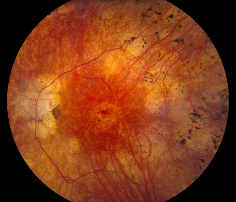 Fotografía circular del fondo de ojo que muestra una extensa decoloración rojiza-anaranjada y cicatrices en la retina central, con vasos sanguíneos ramificados visibles y depósitos pigmentados oscuros dispersos. Se observa una lesión más oscura a la izquierda del centro, y cambios retinianos irregulares se extienden por toda la imagen, lo que sugiere un daño retiniano significativo.