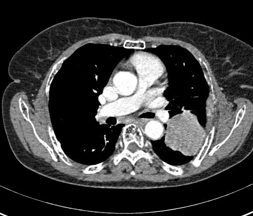 HIV patients diagnosed with lung cancer at a younger age