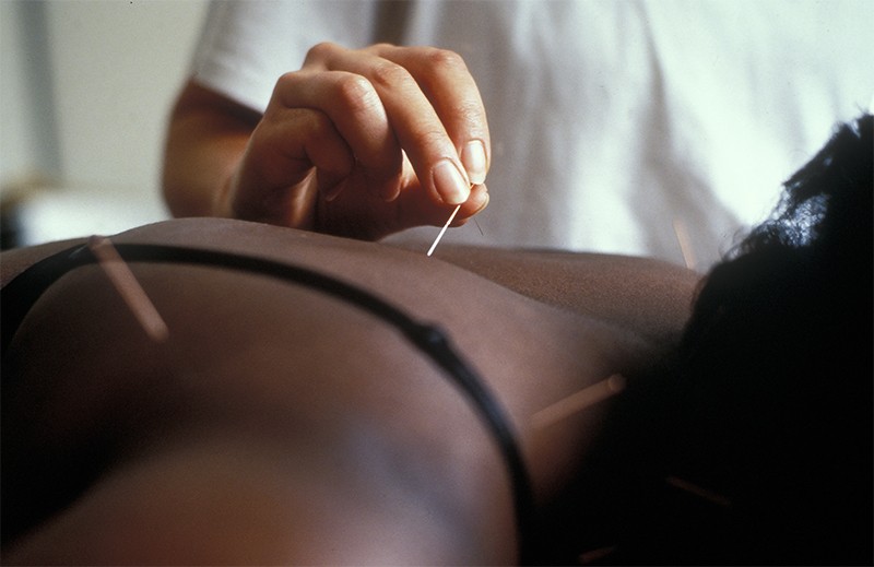 A woman receiving acupuncture, UK.