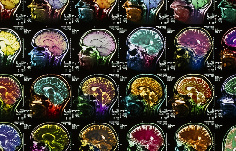 Collage di scansioni MRI sagittali colorate del cervello umano.