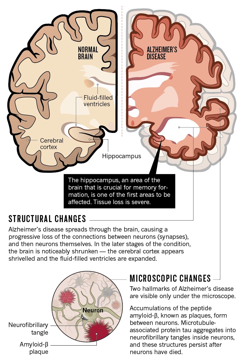 Structural and microscopic changes in the brain in Alzheimer's disease.