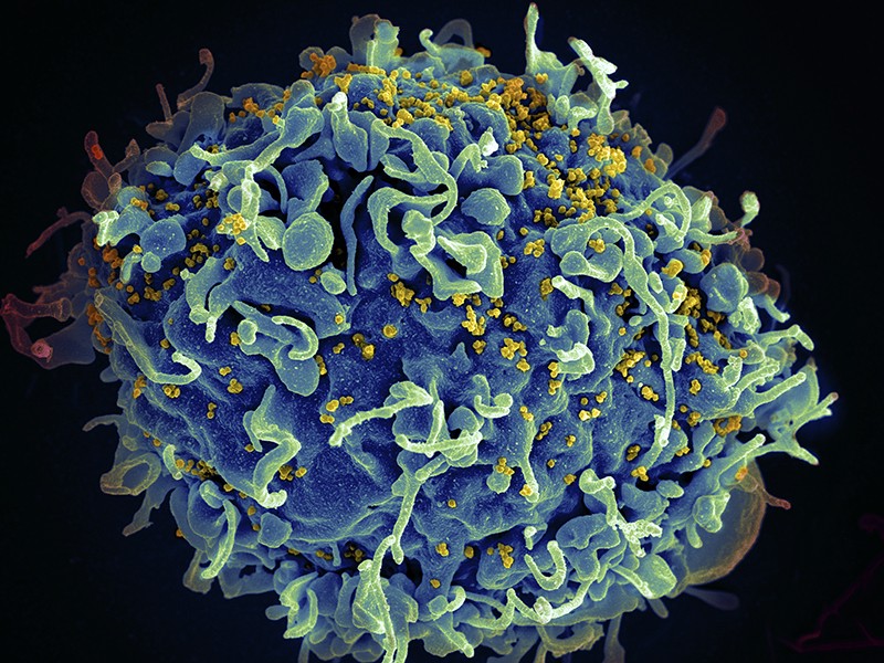 Second patient free of HIV after stem-cell therapy