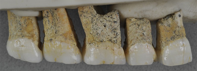 5 right upper teeth of the Homo luzonensis individual CCH6
