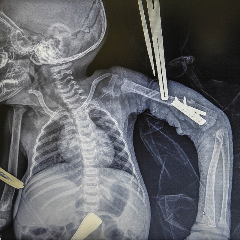 An X-ray showing a Sumatran baby orangutan with a badly fractured arm