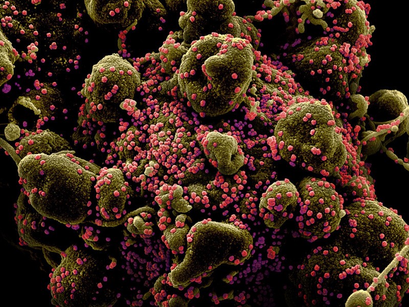 Colorized SEM of an apoptotic cell (greenish brown) heavily infected by COVID-19 (pink).