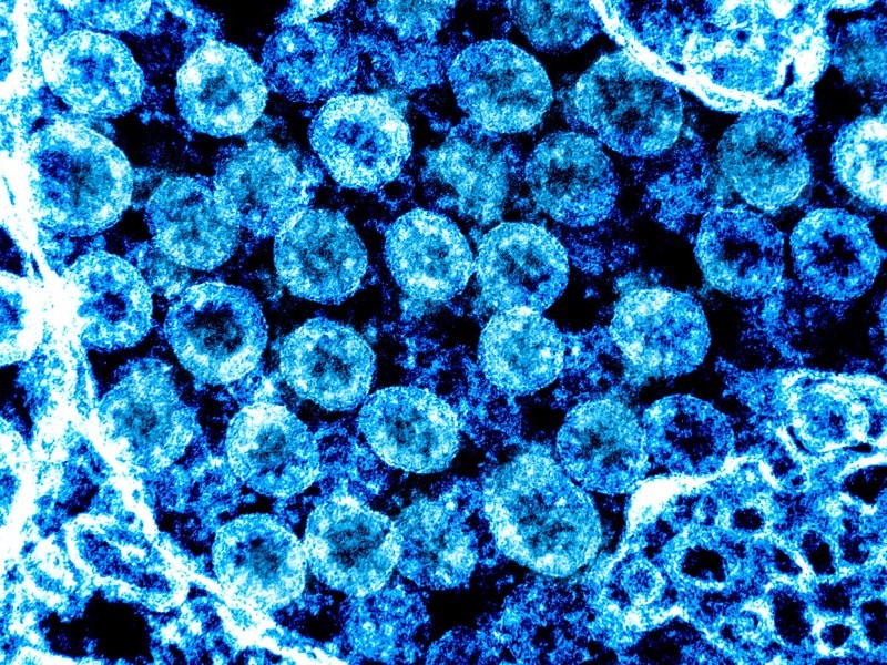 TEM of SARS-CoV-2 virus particles.