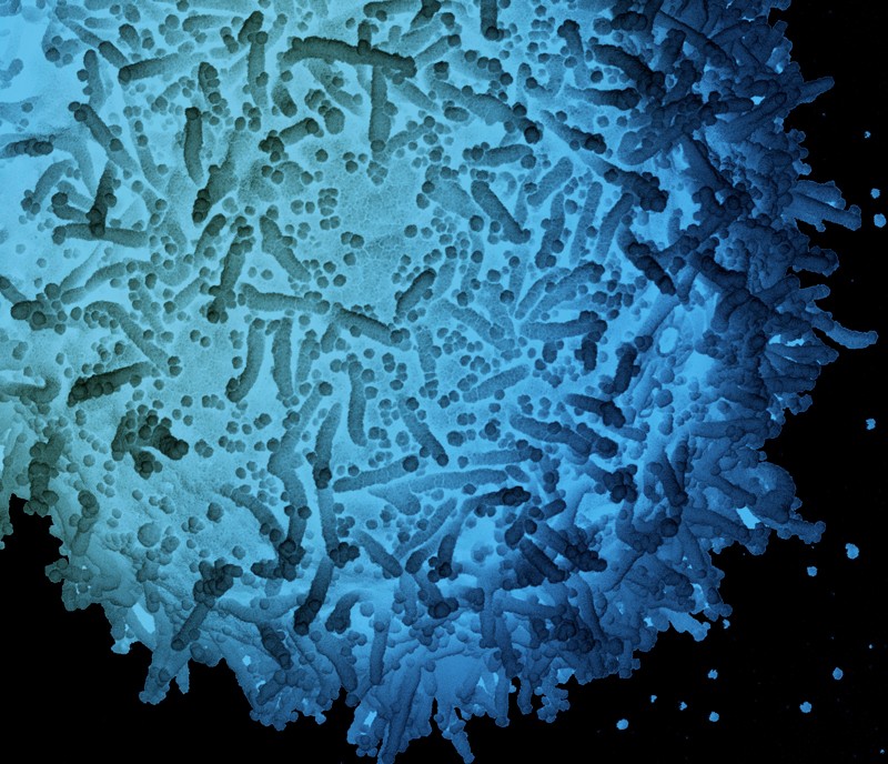 Coloured scanning electron micrograph of a cell infected by SARS-CoV-2 particles