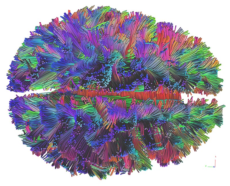 White matter connections in varying colours for a single subject, as measured using diffusion-weighted MRI.