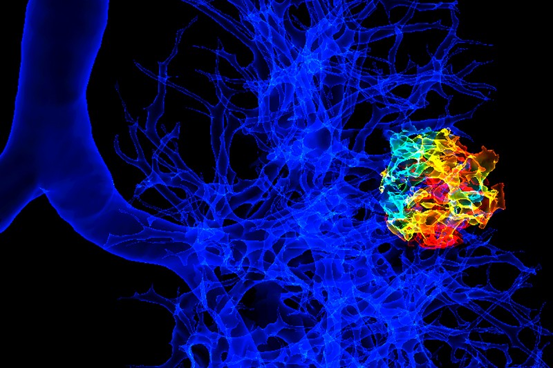 Coloured 3D computed tomography scan of human lungs with a cancer