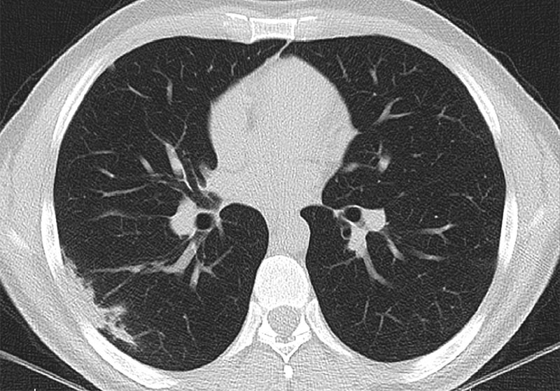 CT chest of a 44-year-old man with COVID-19, who returned for follow-up imaging 34 days after the initial presentation