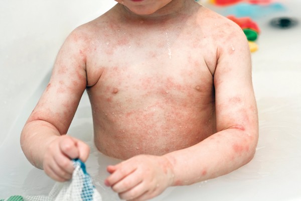 A child in a bath whose torso amd arms are covered in a rash