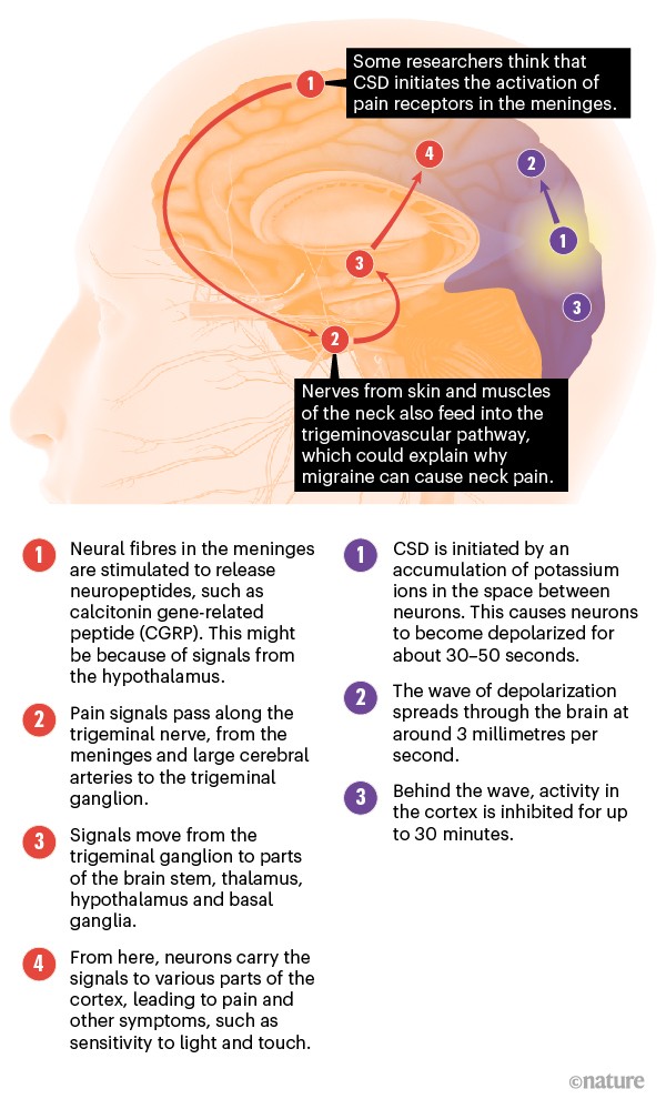 A Visual Guide To Migraine Headaches