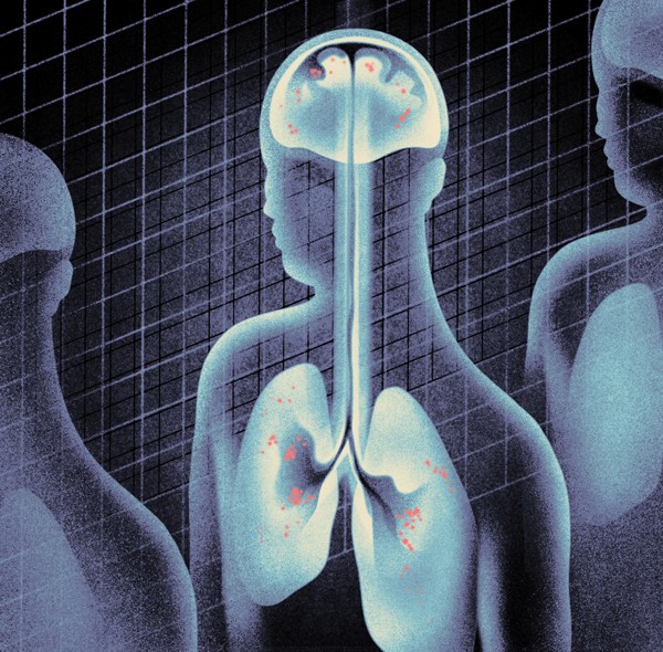 What Happens When Lung Cancer Spreads To The Brain