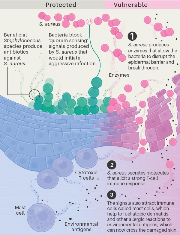 Graphic exploring the link between Staphylococcus and atopic dermatitis