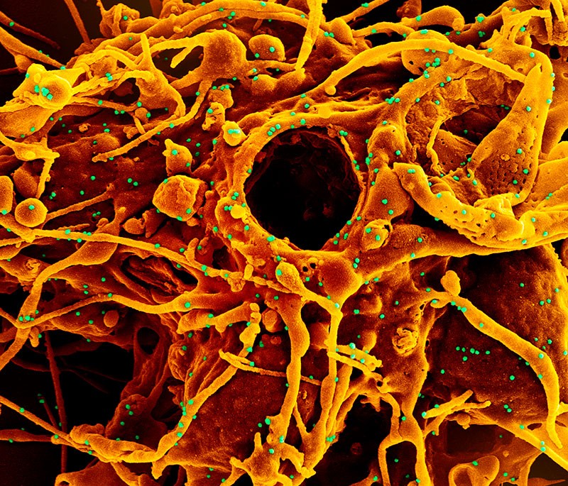 Coloured SEM showing a cell (orange) being infected with UK B.1.1.7 variant SARS-CoV-2 virus particles (green).