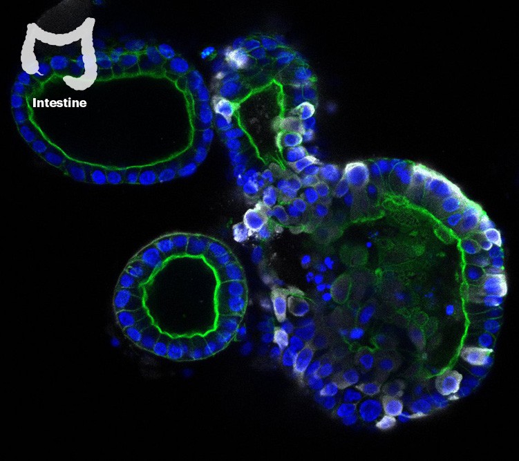Fluorescence image of an organoid grown from human intestinal cells being infected by SARS-CoV-2.