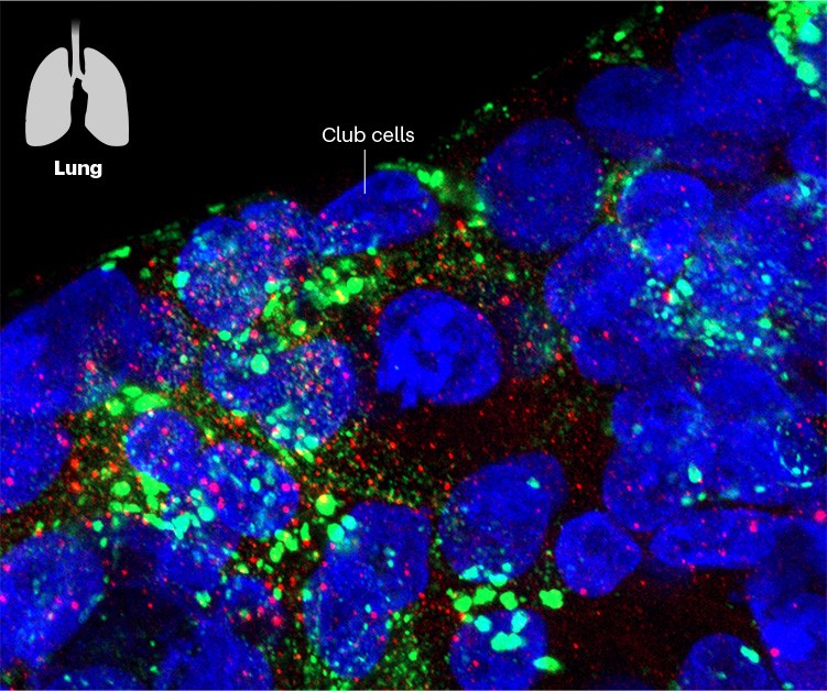 Fluorescence image of an organoid grown from human lung cells being infected by SARS-CoV-2.