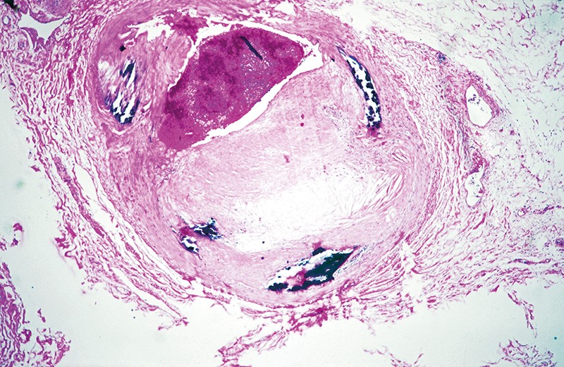 Inflammation in heart disease do researchers know enough?
