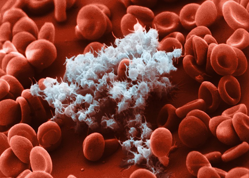 Coloured scanning electron micrograph of activated platelets (white) and red blood cells as a blood clot begins to form.
