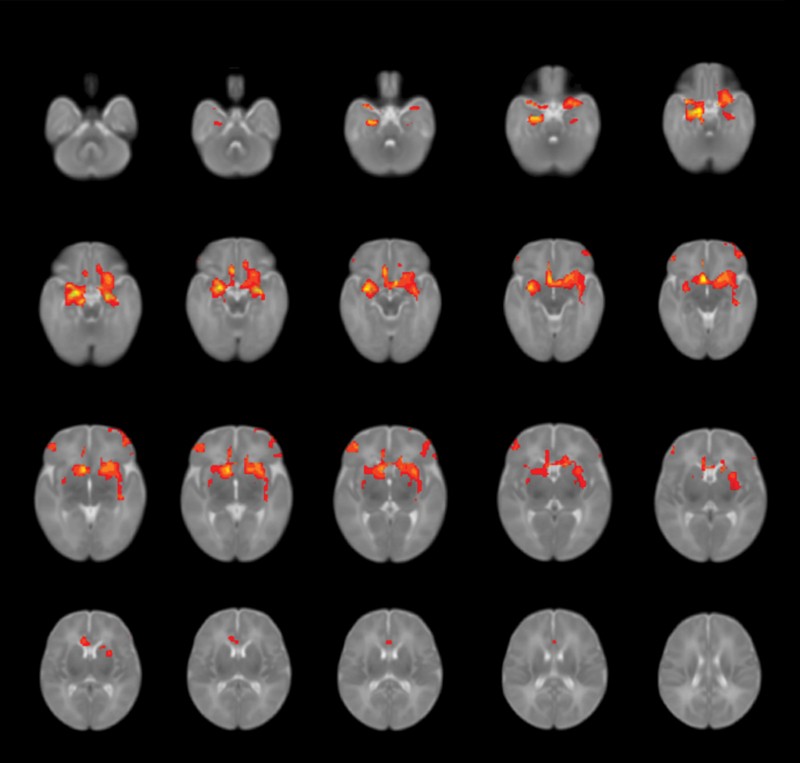 Composite of MRI scans of brains showing amygdala functional connectivity in infants born during born during the pandemic