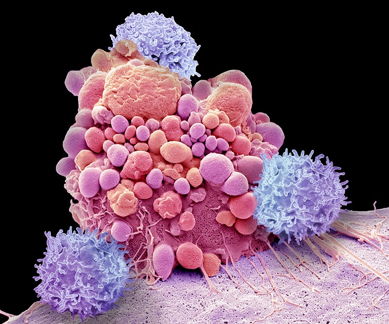 Composite coloured scanning electron micrograph (SEM) of T cells and an apoptotic brain cancer cell.