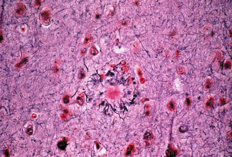 Light micrograph of a section through the brain showing an amyloid plaque (centre), from a patient with Alzheimer's disease.