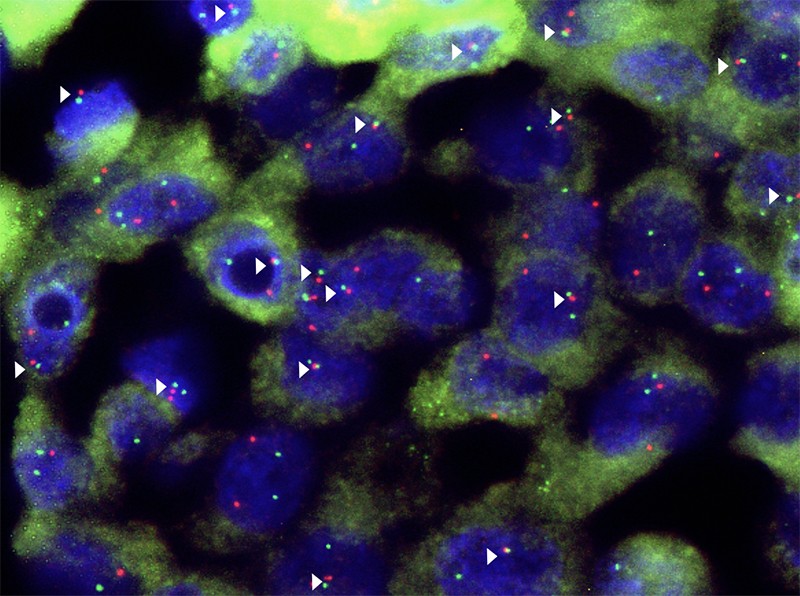 Micrograph of liver tumour cells