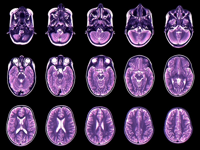 Colored magnetic resonance imaging (MRI) scans in axial section of a young boy's healthy brain.