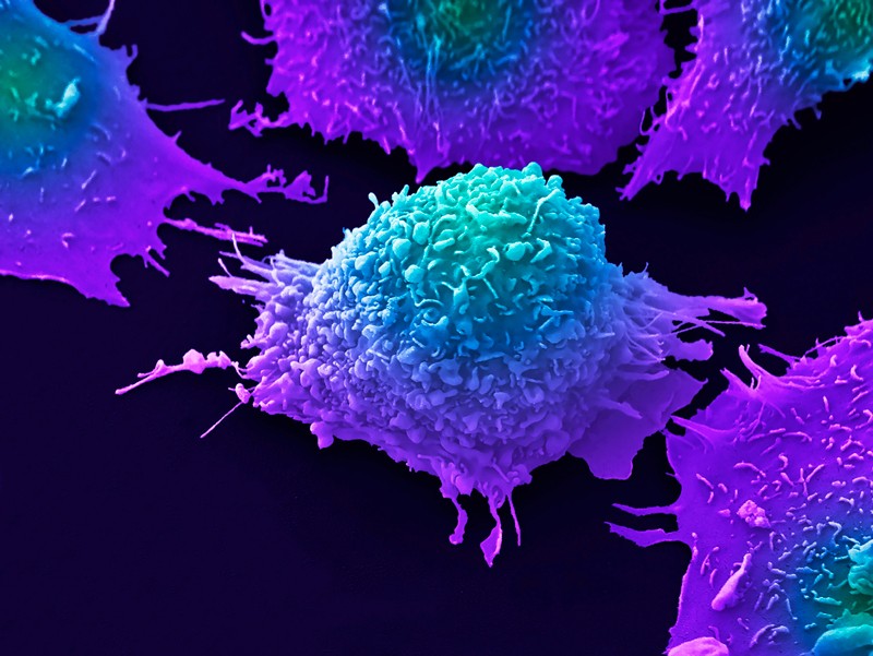 Coloured scanning electron micrograph of lung cancer cells