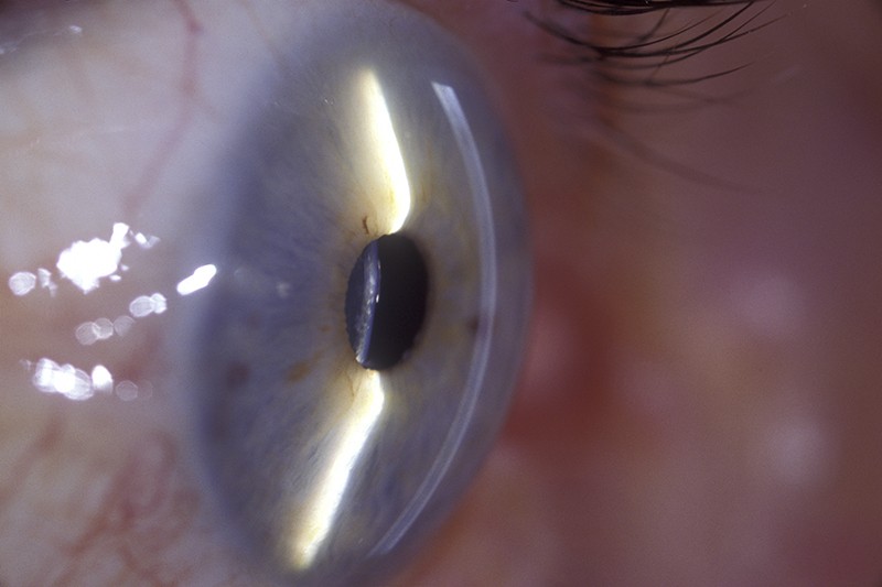 Spleetlamp oogonderzoek van het hoornvlies, het transparante voorste deel van het oog en iris van een gezond menselijk rechteroog.