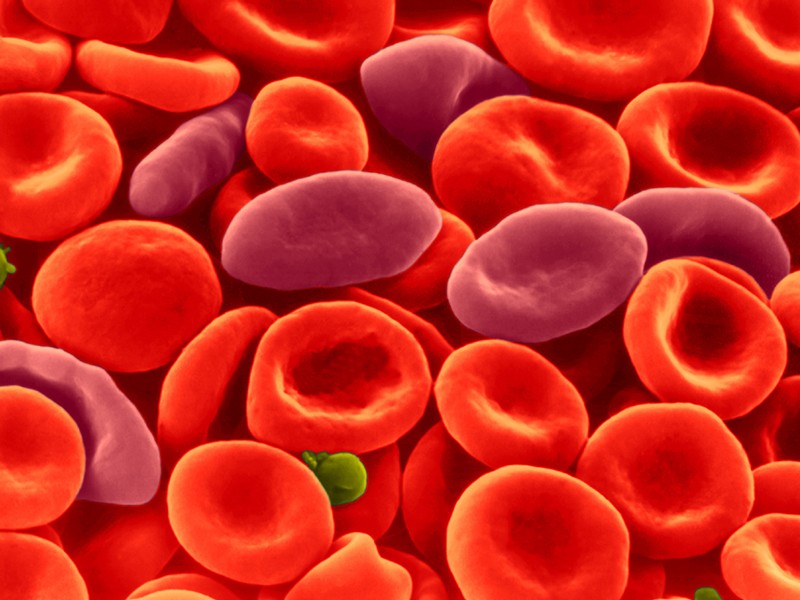 Sickle red blood cells (oblong, tapered cells) among healthy red blood cells (human), SEM.