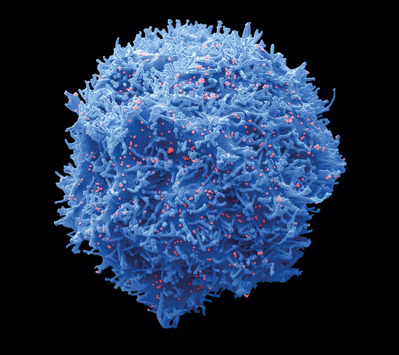 Micrograph of a human cell with coronoavirus attached to its surface