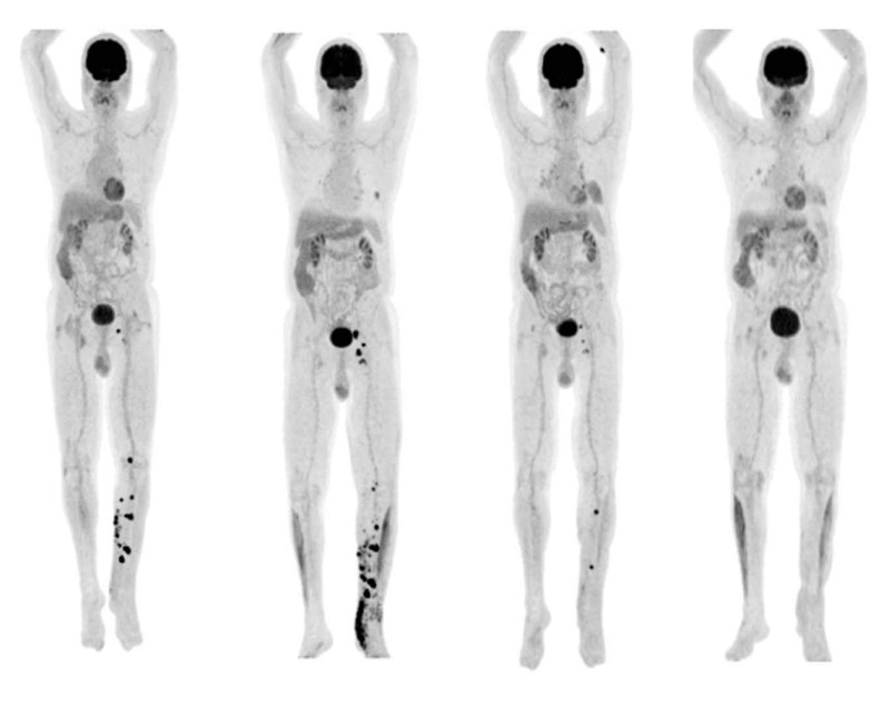 PET-CT scans of a patient at different stages of treatment with fecal microbiota transplant showing lesions reducing over time