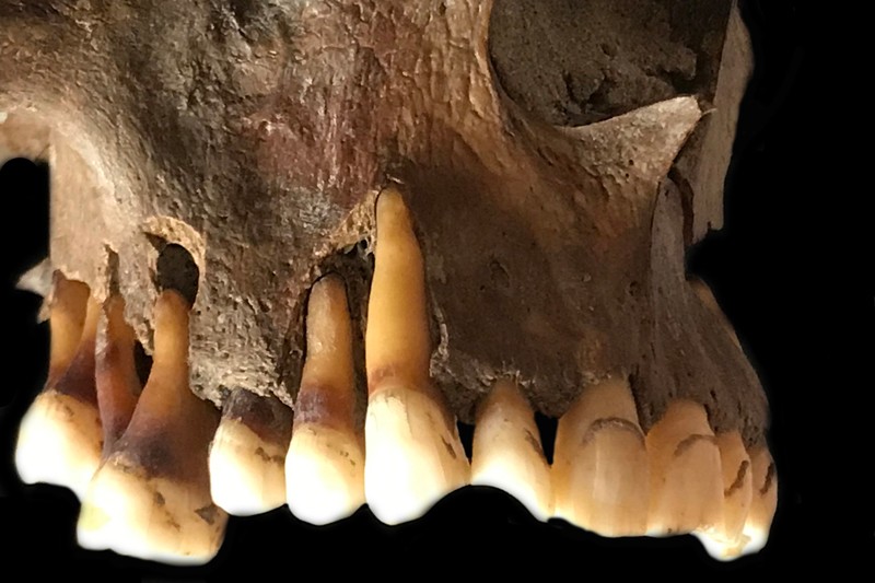 The dental remains of a male whose teeth have been worn down by a clay pipe