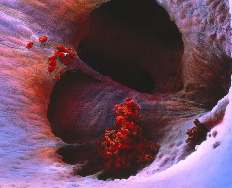 An SEM showing a cave like chamber in a heart with a blood clot in the centre
