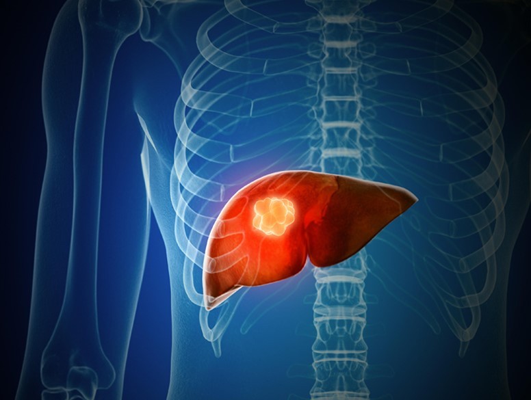 A new treatment combination for liver cancer