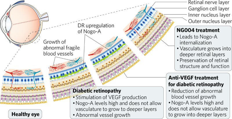 diabetic retinopathy treatment)