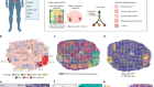 Spatially resolved clonal copy number alterations in benign and malignant tissue