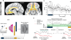 Cingulate dynamics track depression recovery with deep brain stimulation
