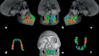 Dental evidence for extended growth in early Homo from Dmanisi