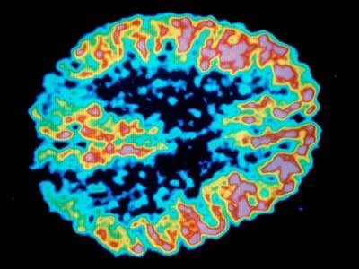 FDA approves Alzheimer's drug lecanemab amid safety concerns - Nature.com