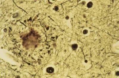 Alzheimer’s drug donanemab helps most when taken at earliest illness stage, examine finds