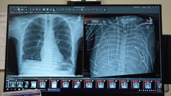 Pria Bertahan 48 Jam Tanpa Paru dengan Sistem Paru Buatan yang Revolusioner